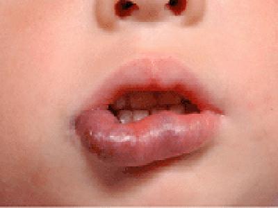 Gezwollen lip: vier oorzaken van malaise
